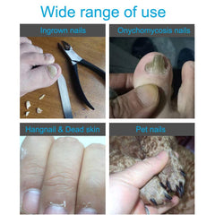 RKPM HOMES By 4Pcs Ingrown Toe Nail Clippers Tool Set, Stainless Steel Professional Ingrown or Thick Toenails Trimmer, Nail Clipper, Cuticle Fork, Nail File, Nail Cleaner Tool (Blue)